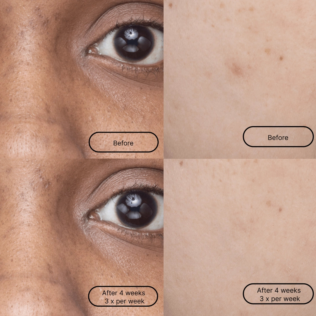 dark spot single mask
